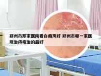 郑州市那家医院看白癜风好 郑州市哪一家医院治痔疮治的最好