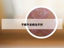 干嘛牛皮癣治不好