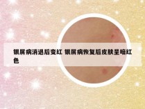 银屑病消退后变红 银屑病恢复后皮肤呈暗红色