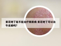 紫花地丁能不能治疗银屑病 紫花地丁可以治牛皮癣吗?