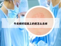 牛皮癣好后腿上的疤怎么去掉