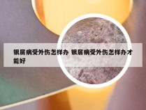 银屑病受外伤怎样办 银屑病受外伤怎样办才能好