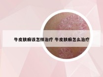 牛皮肤癣该怎样治疗 牛皮肤癣怎么治疗