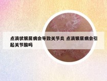 点滴状银屑病会导致关节炎 点滴银屑病会引起关节酸吗