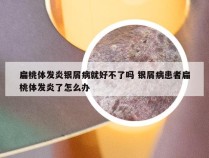扁桃体发炎银屑病就好不了吗 银屑病患者扁桃体发炎了怎么办