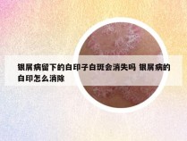 银屑病留下的白印子白斑会消失吗 银屑病的白印怎么消除