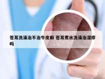 苍耳洗澡治不治牛皮癣 苍耳煮水洗澡治湿疹吗