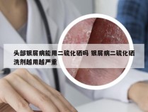 头部银屑病能用二硫化硒吗 银屑病二硫化硒洗剂越用越严重