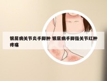 银屑病关节炎手脚肿 银屑病手脚指关节红肿疼痛