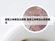 屁股上有癣怎么回事 屁股上有癣怎么回事图片