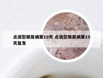 点滴型银屑病第19天 点滴型银屑病第19天复发