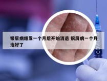 银屑病爆发一个月后开始消退 银屑病一个月治好了