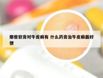 那些软膏对牛皮癣有 什么药膏治牛皮癣最好使