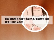 银屑病和强直性脊柱炎的关系 银屑病和强直性脊柱炎的关系图