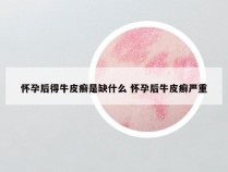 怀孕后得牛皮癣是缺什么 怀孕后牛皮癣严重