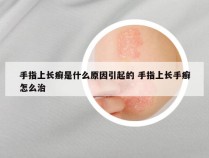 手指上长癣是什么原因引起的 手指上长手癣怎么治