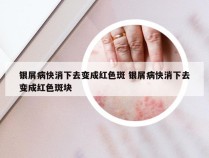 银屑病快消下去变成红色斑 银屑病快消下去变成红色斑块
