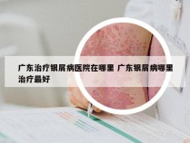 广东治疗银屑病医院在哪里 广东银屑病哪里治疗最好