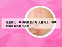 儿童身上一块块的癣怎么办 儿童身上一块块的癣怎么办用什么药
