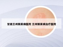 甘肃兰州银屑病医院 兰州银屑病治疗医院