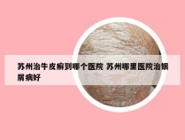 苏州治牛皮癣到哪个医院 苏州哪里医院治银屑病好
