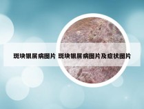 斑块银屑病图片 斑块银屑病图片及症状图片