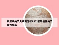 银屑病关节炎病例分析PPT 银屑病性关节炎大病历