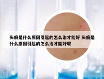 头癣是什么原因引起的怎么治才能好 头癣是什么原因引起的怎么治才能好呢