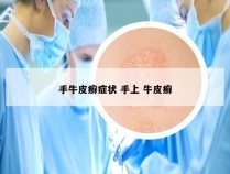 手牛皮癣症状 手上 牛皮癣