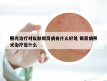 照光治疗对皮肤银屑病有什么好处 银屑病照光治疗是什么