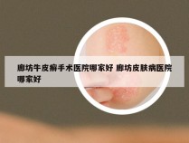 廊坊牛皮癣手术医院哪家好 廊坊皮肤病医院哪家好