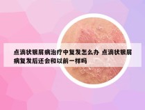 点滴状银屑病治疗中复发怎么办 点滴状银屑病复发后还会和以前一样吗