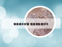 银屑病不好看 银屑病能看好不