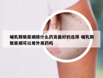 哺乳期银屑病擦什么药膏最好的选择 哺乳期银屑病可以用外用药吗
