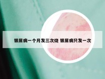 银屑病一个月发三次烧 银屑病只发一次