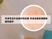 天津专治牛皮癣疗院在那 天津治银屑病哪里医院最好