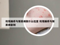 玫瑰糠疹与银屑病做什么检查 玫瑰糠疹与银屑病鉴别