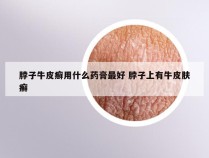 脖子牛皮癣用什么药膏最好 脖子上有牛皮肤癣