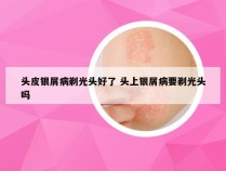 头皮银屑病剃光头好了 头上银屑病要剃光头吗