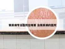 银屑病专治医院在哪里 治银屑病的医院