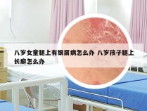 八岁女童腿上有银屑病怎么办 八岁孩子腿上长癣怎么办