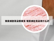 银屑病割耳朵那里有 银屑病在耳朵用什么药