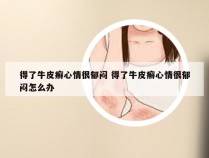 得了牛皮癣心情很郁闷 得了牛皮癣心情很郁闷怎么办