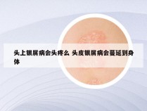头上银屑病会头疼么 头皮银屑病会蔓延到身体