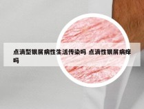 点滴型银屑病性生活传染吗 点滴性银屑病痒吗