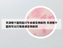 天津哪个医院能打牛皮癣生物制剂 天津哪个医院可以打银屑病生物制剂