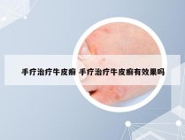 手疗治疗牛皮癣 手疗治疗牛皮癣有效果吗