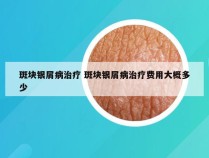 斑块银屑病治疗 斑块银屑病治疗费用大概多少
