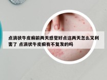 点滴状牛皮癣前两天感觉好点这两天怎么又利害了 点滴状牛皮癣有不复发的吗