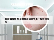 银屑病和铁 银屑病铁屑铝条中毒一般持续多久